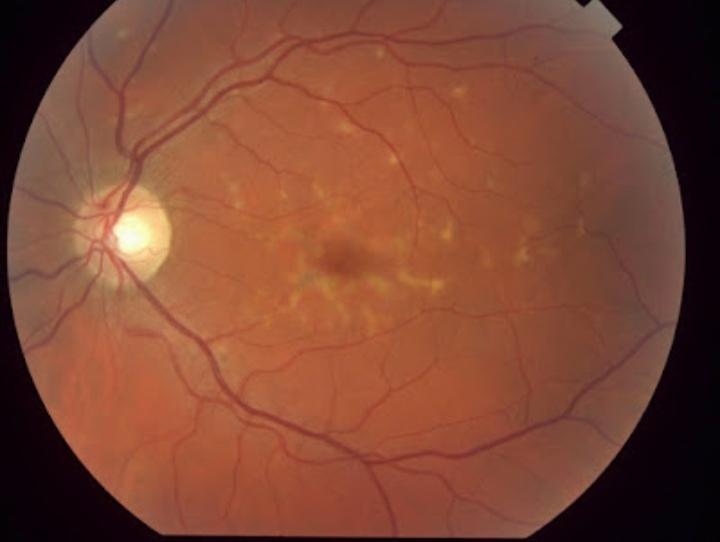 Pattern Dystrophies