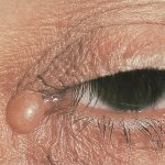 Apocrine Hidrocystoma