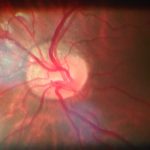 Tilted Disc Syndrome
