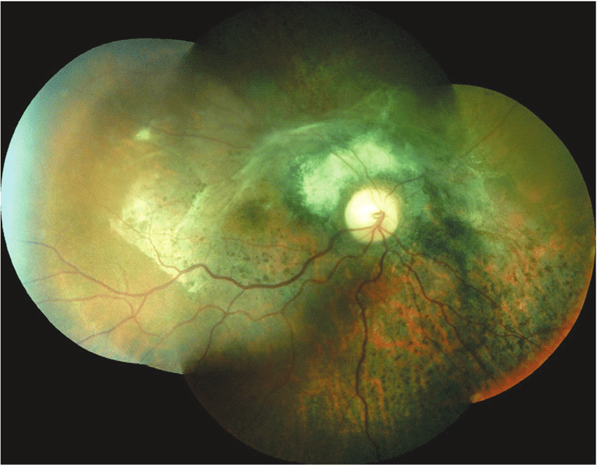 Chorioretinitis Sclopetaria