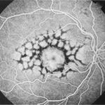 Pattern Dystrophies