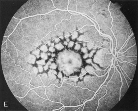 Pattern dystrophies: full report