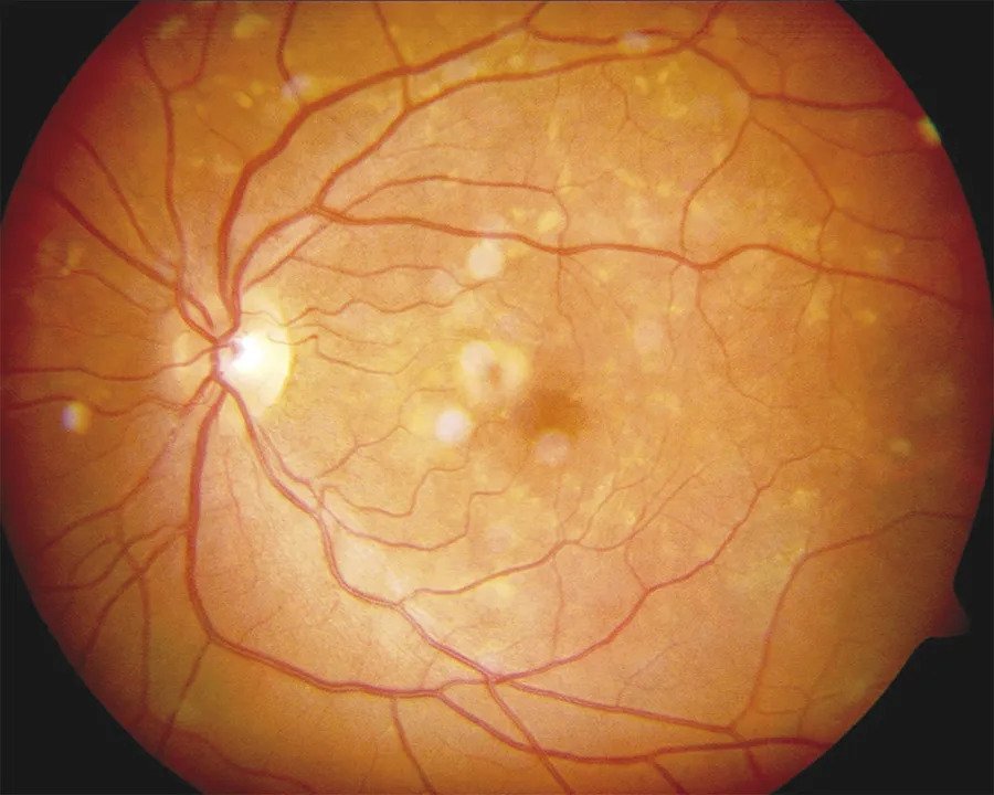 Pattern Dystrophies