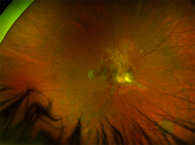 Retinal astrocytic hamartoma