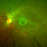 Torpedo Maculopathy