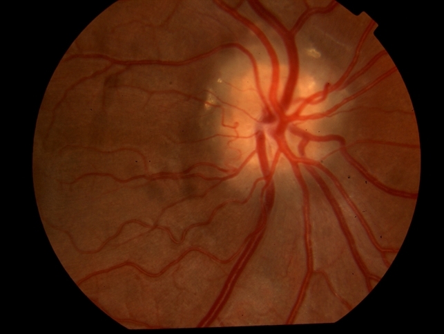 Optic disc drusen