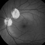 Retinal astrocytic hamartoma