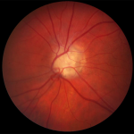 Optic disc drusen