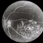 Solar Retinopathy