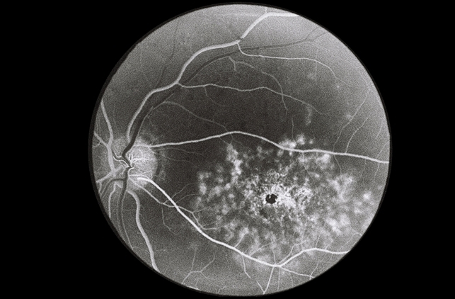 solar retinopathy: An in-depth look