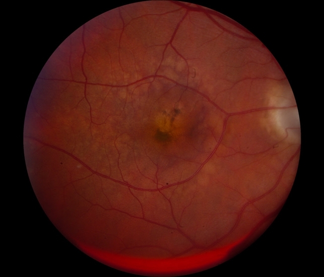 Pigment Epithelial detachment(PED)
