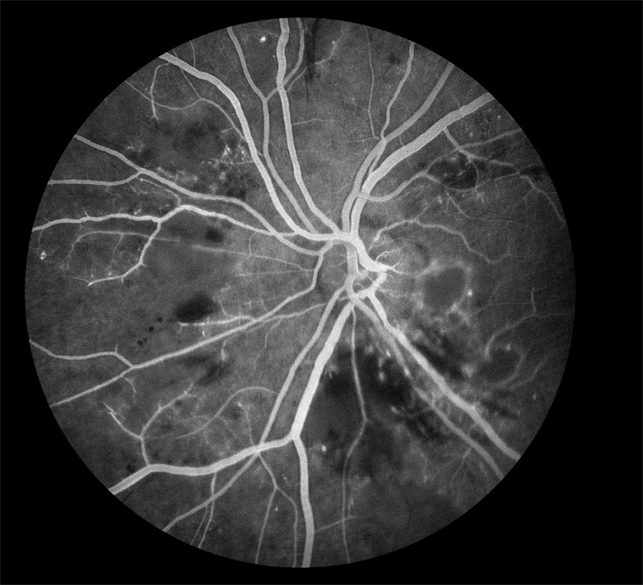 Radiation Retinopathy