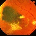 Radiation Retinopathy