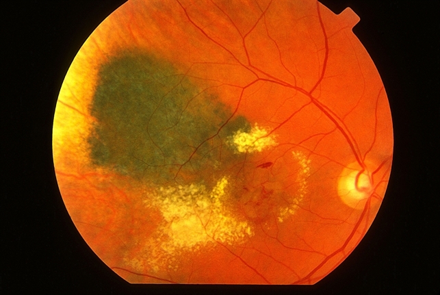 Radiation Retinopathy: case study and full review