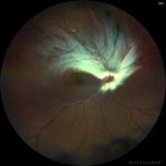 Straatsma syndrome
