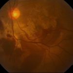 Chorioretinitis Sclopetaria