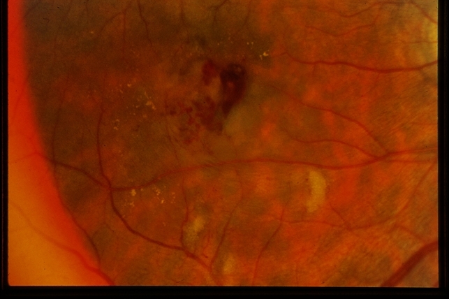 Radiation Retinopathy