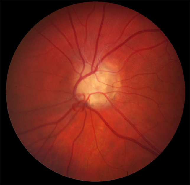 Optic disc drusens: ALL YOU NEED TO KNOW