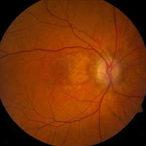 Pseudoxanthoma Elasticum