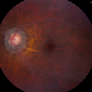 Lipemia retinalis 