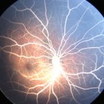 Lipemia retinalis
