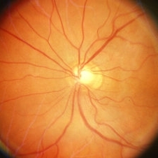 Cystoid macular edema