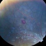 Malarial Retinopathy