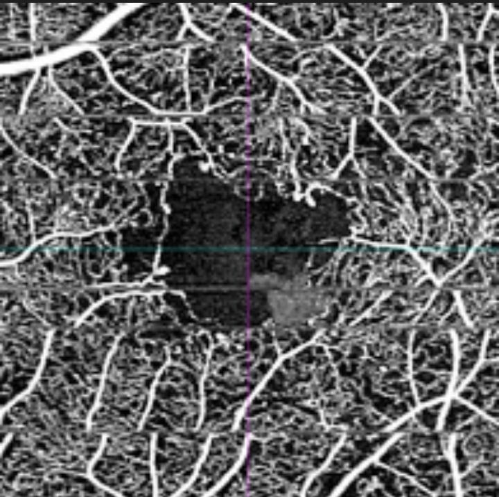 Diabetic Macular ischemia