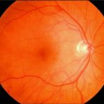 Diabetic Macular ischemia