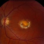 North Carolina Macular Dystrophy
