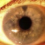 Brown McLean Syndrome