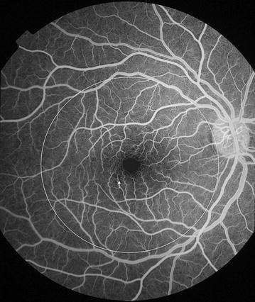 Malarial Retinopathy