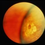 Atrophic Retinal Holes