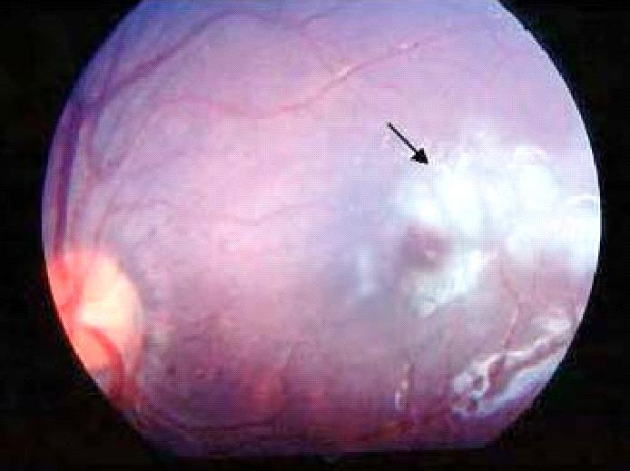 Malarial Retinopathy