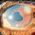 Iris Cysts
