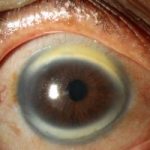 Cornea Plana