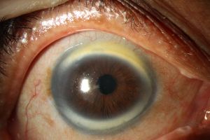 Cornea Plana: A Practical Guide for Ophthalmologists