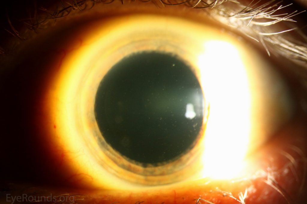 Fleck corneal dystrophy