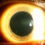 Fleck corneal dystrophy