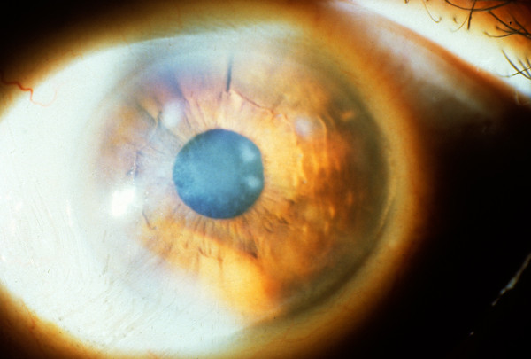 Fleck corneal dystrophy