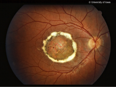 North Carolina Macular Dystrophy