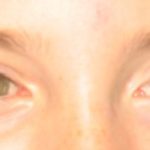 Norrie disease