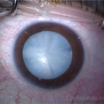 White Cataracts