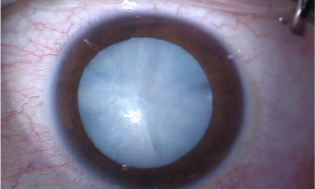 White Cataracts: Recognition, Diagnosis, and Treatment