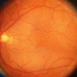 Cystoid Macular edema