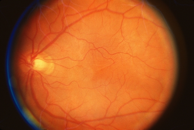 Cystoid Macular edema: case study, description and management