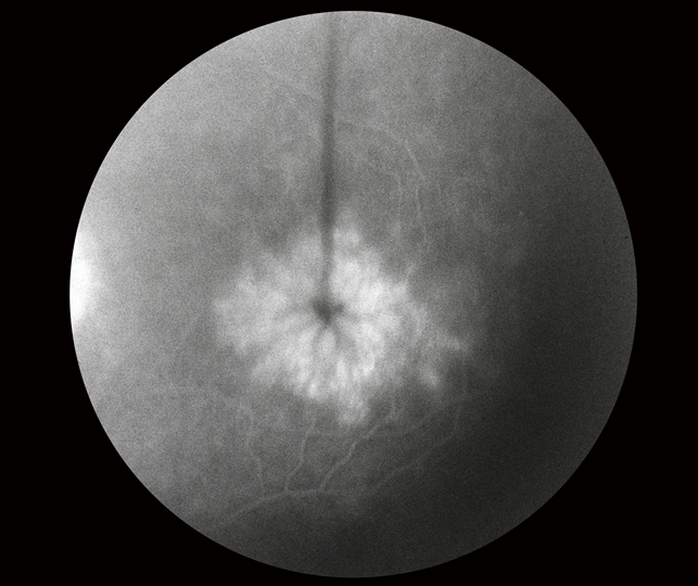 Cystoid Macular edema