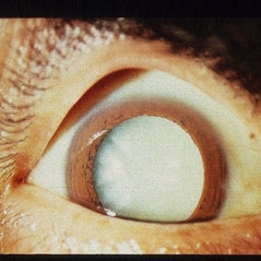 White Cataracts
