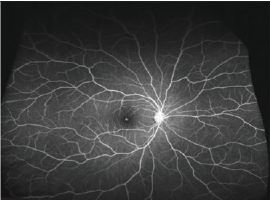 Atrophic Retinal Holes