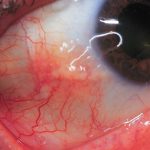 Episcleritis